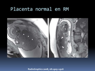 Placenta normal en RM




      RadioGraphics 2008; 28:1905–1916
 