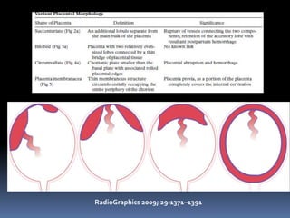 RadioGraphics 2009; 29:1371–1391
 