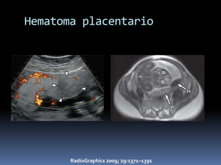Hematoma placentario




       RadioGraphics 2009; 29:1371–1391
 