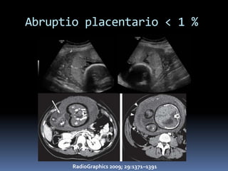Abruptio placentario < 1 %




       RadioGraphics 2009; 29:1371–1391
 
