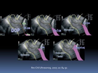 Rev Chil Ultrasonog. 2007; 10: 84-91
 