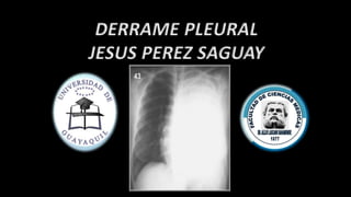 DERRAME PLEURAL
JESUS PEREZ SAGUAY
 