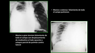 • Masivo o extenso: Velamiento de todo
el campo pulmonar.
• Masivo a gran tension.Velamiento de
todo el campo con desplazamiento
de mediastino al lado opuesto y
colapso parcial de pulmón contra
lateral
 