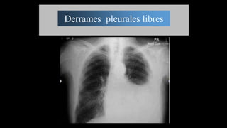 Derrames pleurales libres
 