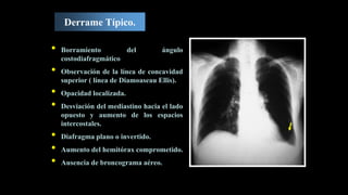 Derrame Típico.
• Borramiento del ángulo
costodiafragmático
• Observación de la línea de concavidad
superior ( línea de Diamoaseau Ellis).
• Opacidad localizada.
• Desviación del mediastino hacia el lado
opuesto y aumento de los espacios
intercostales.
• Diafragma plano o invertido.
• Aumento del hemitórax comprometido.
• Ausencia de broncograma aéreo.
 