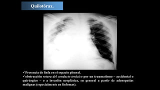 Quilotórax.
Presencia de linfa en el espacio pleural.
obstrucción rotura del conducto torácico por un traumatismo – accidental o
quirúrgico – o a invasión neoplásica, en general a partir de adenopatías
malignas (especialmente en linfomas).
 