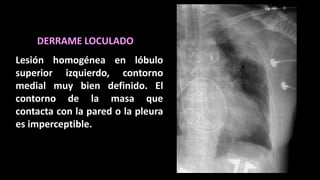 Lesión homogénea en lóbulo
superior izquierdo, contorno
medial muy bien definido. El
contorno de la masa que
contacta con la pared o la pleura
es imperceptible.
DERRAME LOCULADO
 