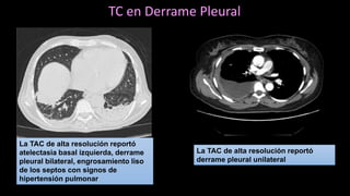 La TAC de alta resolución reportó
atelectasia basal izquierda, derrame
pleural bilateral, engrosamiento liso
de los septos con signos de
hipertensión pulmonar
La TAC de alta resolución reportó
derrame pleural unilateral
TC en Derrame Pleural
 