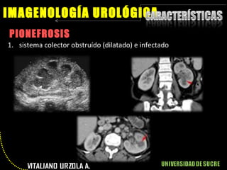 PIONEFROSIS IMAGENOLOGÍA UROLÓGICA sistema colector obstruído (dilatado) e infectado 