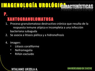P.  XANTOGRANULOMATOSA IMAGENOLOGÍA UROLÓGICA Proceso granulomatoso destructivo crónico que resulta de la  respuesta inmune atípica e incompleta a una infección bacteriana subaguda Se asocia a litiasis piélica y a hidronefrosis Imagen: Litiasis coraliforme Nefromegalia Riñón excluido 
