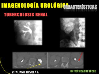 TUBERCULOSIS RENAL IMAGENOLOGÍA UROLÓGICA 
