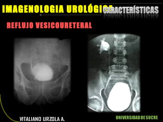 REFLUJO VESICOURETERAL IMAGENOLOGIA UROLÓGICA 