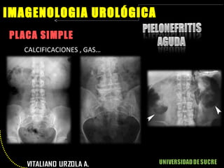 PLACA SIMPLE IMAGENOLOGIA UROLÓGICA CALCIFICACIONES , GAS… 
