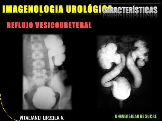 REFLUJO VESICOURETERAL IMAGENOLOGIA UROLÓGICA 