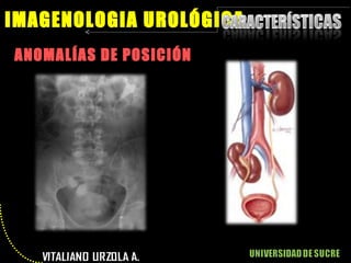 ANOMALÍAS DE POSICIÓN IMAGENOLOGIA UROLÓGICA 