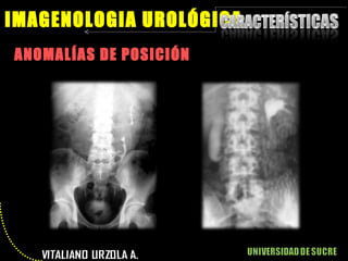 ANOMALÍAS DE POSICIÓN IMAGENOLOGIA UROLÓGICA 