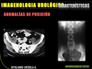 ANOMALÍAS DE POSICIÓN IMAGENOLOGIA UROLÓGICA 