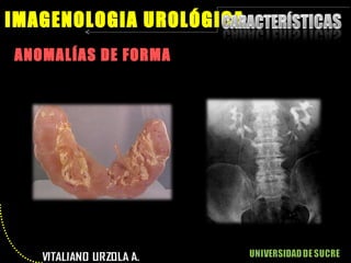 ANOMALÍAS DE FORMA IMAGENOLOGIA UROLÓGICA 