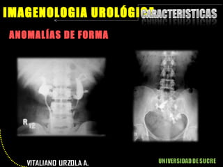 ANOMALÍAS DE FORMA IMAGENOLOGIA UROLÓGICA 