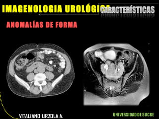 ANOMALÍAS DE FORMA IMAGENOLOGIA UROLÓGICA 