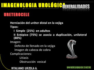 URETEROCELE IMAGENOLOGIA UROLÓGICA Herniación del uréter distal en la vejiga Tipos:  I  Simple  (25%)  en adultos II Ectópico (75%) se asocia a duplicación, unilateral (80%) Imagen:   Defecto de llenado en la vejiga   Imagen de cabeza de cobra Complicaciones: Litiasis Obstrucción  vesical 