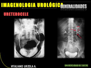 URETEROCELE IMAGENOLOGIA UROLÓGICA 