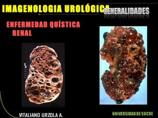 ENFERMEDAD QUÍSTICA RENAL IMAGENOLOGIA UROLÓGICA 