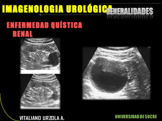 ENFERMEDAD QUÍSTICA RENAL IMAGENOLOGIA UROLÓGICA 