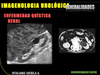 ENFERMEDAD QUÍSTICA RENAL IMAGENOLOGIA UROLÓGICA 