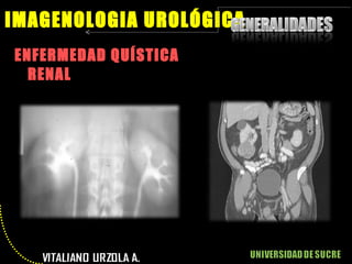 ENFERMEDAD QUÍSTICA RENAL IMAGENOLOGIA UROLÓGICA 
