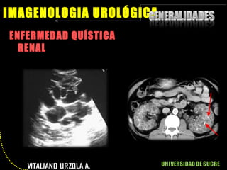 ENFERMEDAD QUÍSTICA RENAL IMAGENOLOGIA UROLÓGICA 