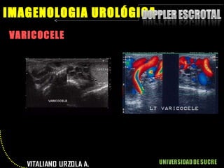VARICOCELE IMAGENOLOGIA UROLÓGICA 