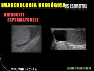 HIDROCELE - ESPERMATOCELE IMAGENOLOGIA UROLÓGICA 