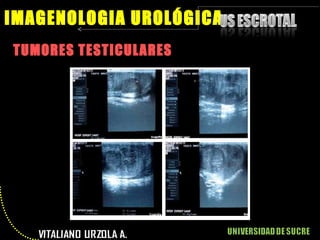 TUMORES TESTICULARES IMAGENOLOGIA UROLÓGICA 