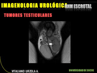 TUMORES TESTICULARES IMAGENOLOGIA UROLÓGICA 