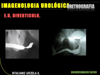 E.U, DIVERTICULO,  IMAGENOLOGIA UROLÓGICA 