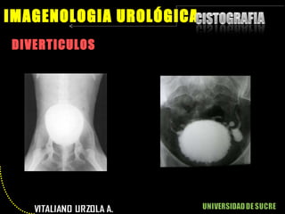 DIVERTICULOS IMAGENOLOGIA UROLÓGICA 
