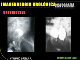 URETEROCELE IMAGENOLOGIA UROLÓGICA 