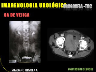 CA DE VEJIGA IMAGENOLOGIA UROLÓGICA 