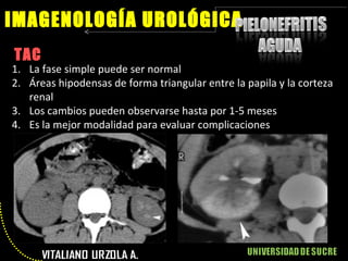 TAC IMAGENOLOGÍA UROLÓGICA La fase simple puede ser normal Áreas hipodensas de forma triangular entre la papila y la corteza renal Los cambios pueden observarse hasta por 1-5 meses Es la mejor modalidad para evaluar complicaciones 