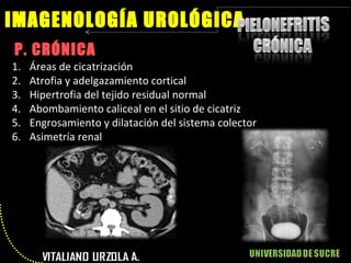 P. CRÓNICA IMAGENOLOGÍA UROLÓGICA Áreas de cicatrización Atrofia y adelgazamiento cortical Hipertrofia del tejido residual normal Abombamiento caliceal en el sitio de cicatriz Engrosamiento y dilatación del sistema colector Asimetría renal 