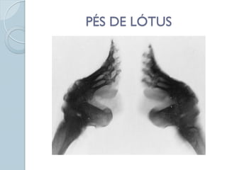 PÉS DE LÓTUS
 