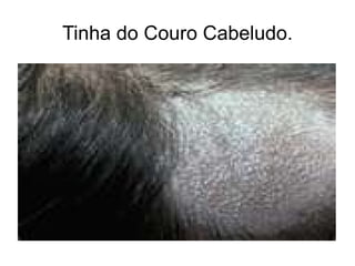 Tinha do Couro Cabeludo. 