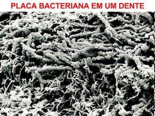 PLACA BACTERIANA EM UM DENTE 