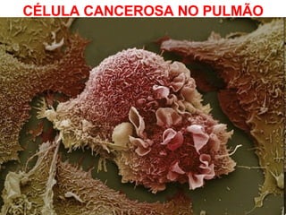 CÉLULA CANCEROSA NO PULMÃO 