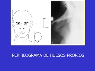 PERFILOGRAMA DE HUESOS PROPIOS 
