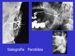 Sialografia  Parotídea 