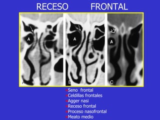 RECESO  FRONTAL Seno  frontal Celdillas frontales Agger nasi Receso frontal Proceso nasofrontal Meato medio 