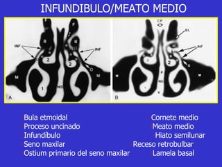 INFUNDIBULO/MEATO MEDIO - Bula etmoidal  - Cornete medio - Proceso uncinado  - Meato medio - Infundíbulo      - Hiato semilunar - Seno maxilar   - Receso retrobulbar - Ostium primario del seno maxilar  - Lamela basal 