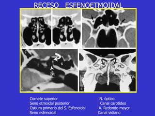RECESO  ESFENOETMOIDAL - Cornete superior  -  N. óptico - Seno etmoidal posterior   -  Canal carotídeo - Ostium primario del S. Esfenoidal  -  A. Redondo mayor - Seno esfenoidal  -  Canal vidiano 